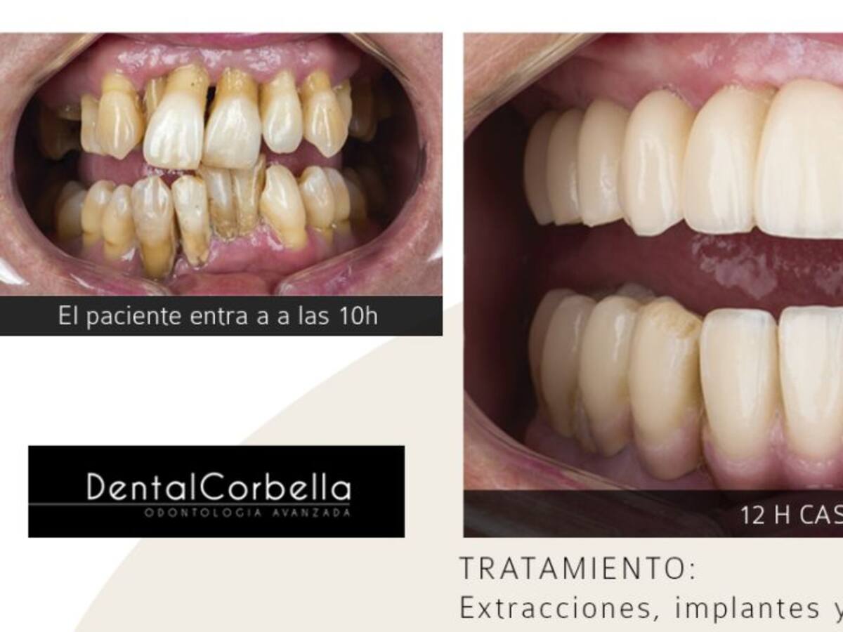 Recupera tu sonrisa en unas horas gracias a la Implantología Dental Avanzada