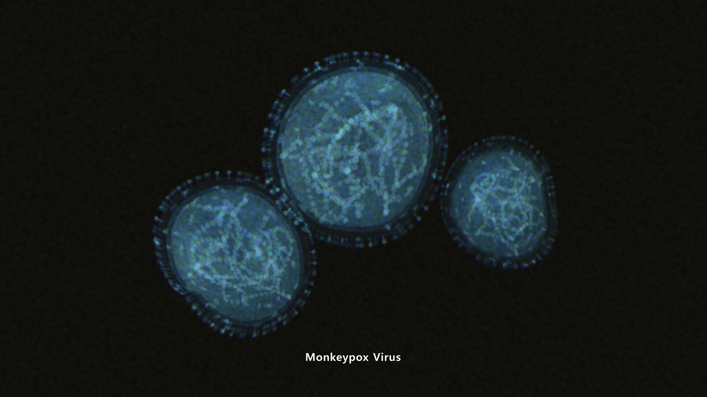 Monkeypox Virus (viruela del mono)