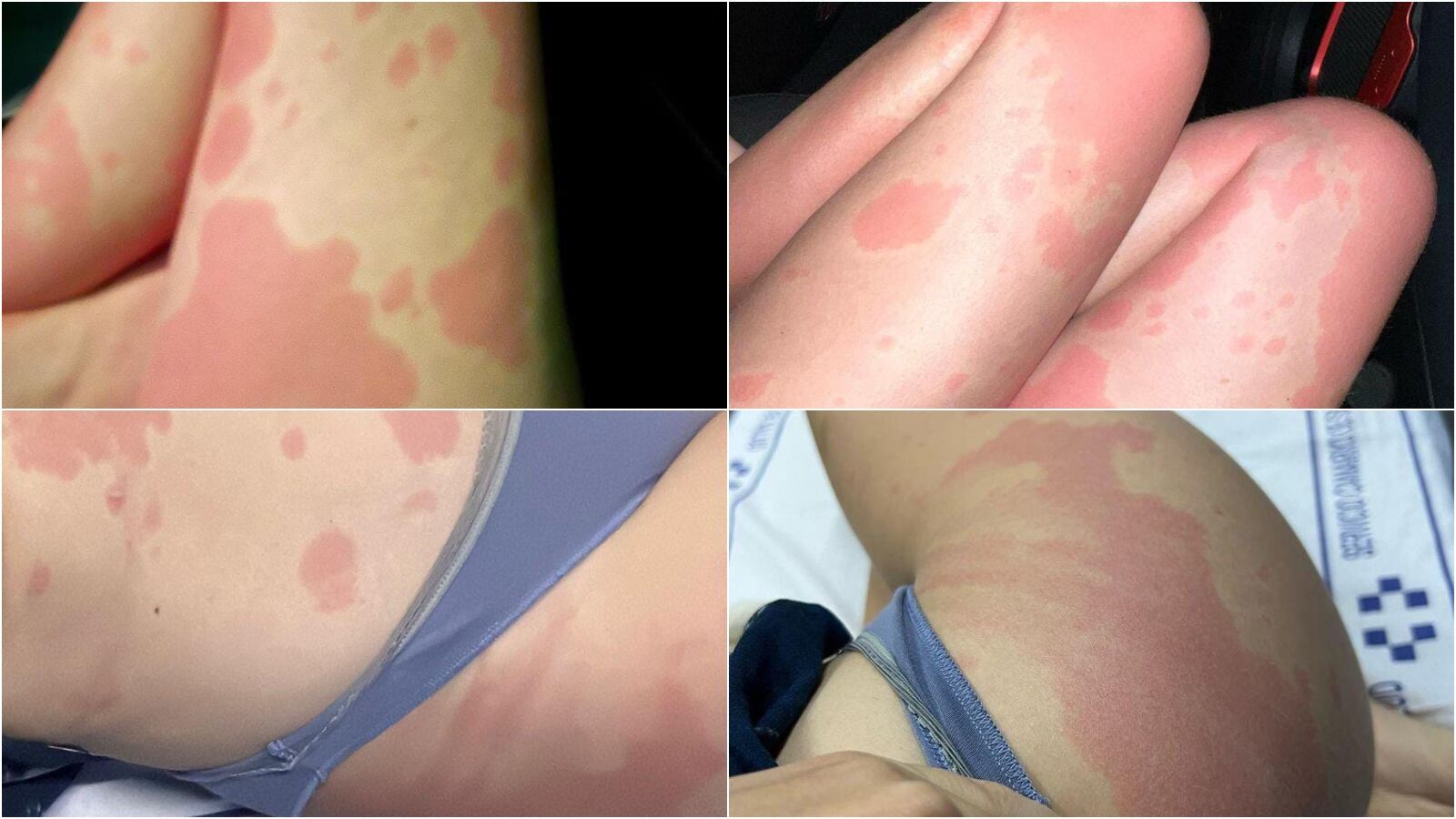 Imágenes de la reacción alérgica producida por la histamina.