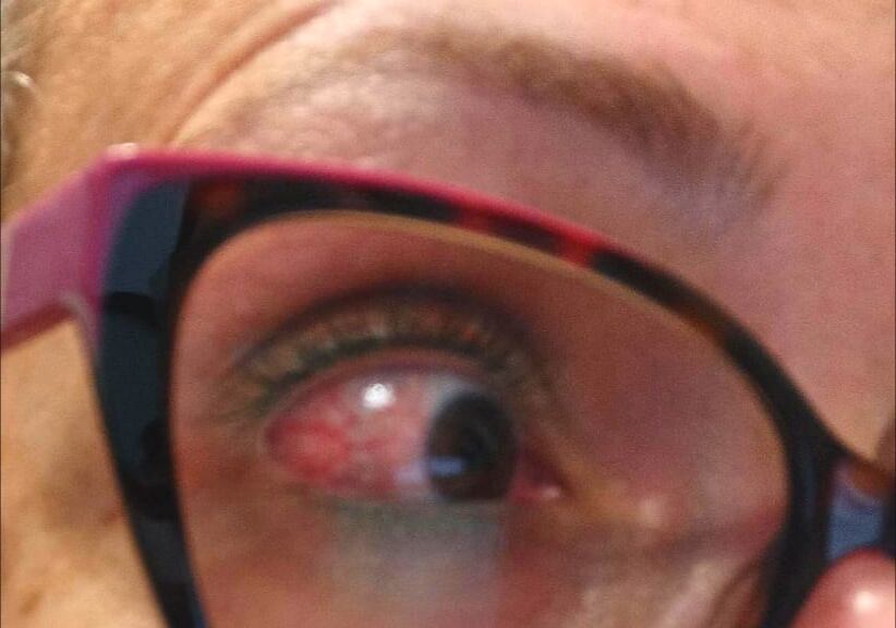 Sintomatología causada en el ojo por la intoxicación en el Laboratorio de Anatomía Patológica del Hospital Universitario de Toledo