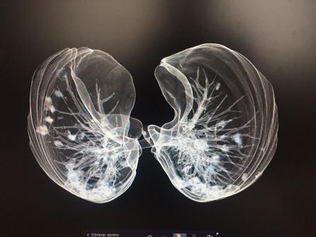 Imagen en 3D reconstruida a partir de la placa de un paciente con COVID-19 en Lanzarote