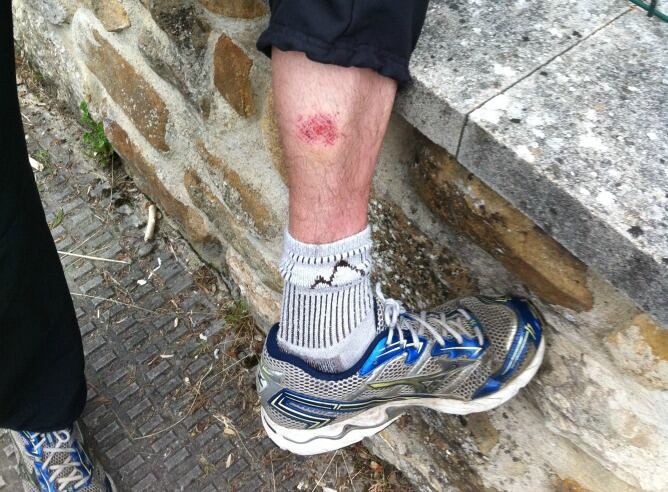 Rasguños y moratones en el gemelo de Urtzi Azkarraga, alavesista de Murgia