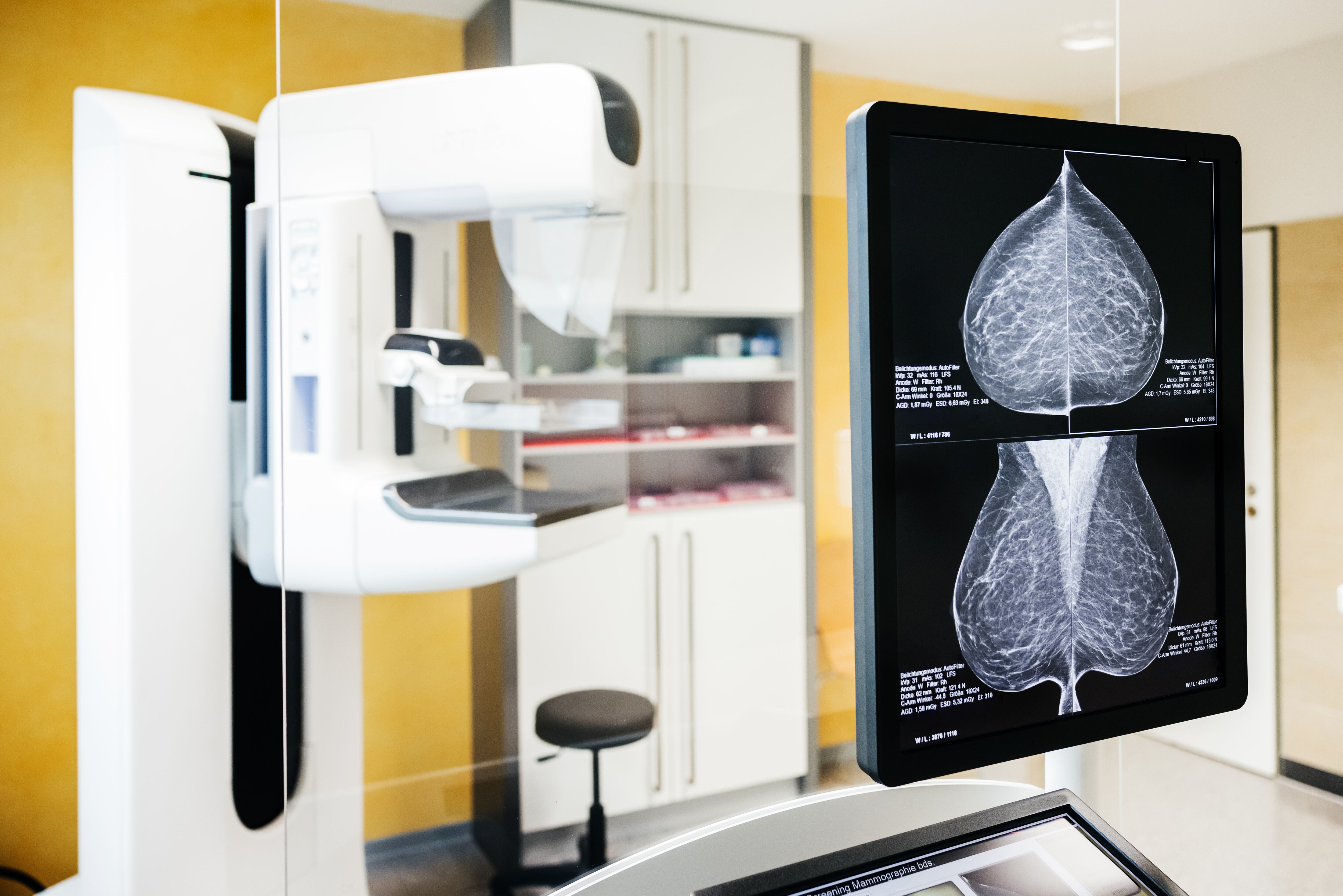 Mammogram results are shown on a digital screen alongside the mammography machine. These images assist healthcare professionals in diagnosing breast abnormalities with precision.