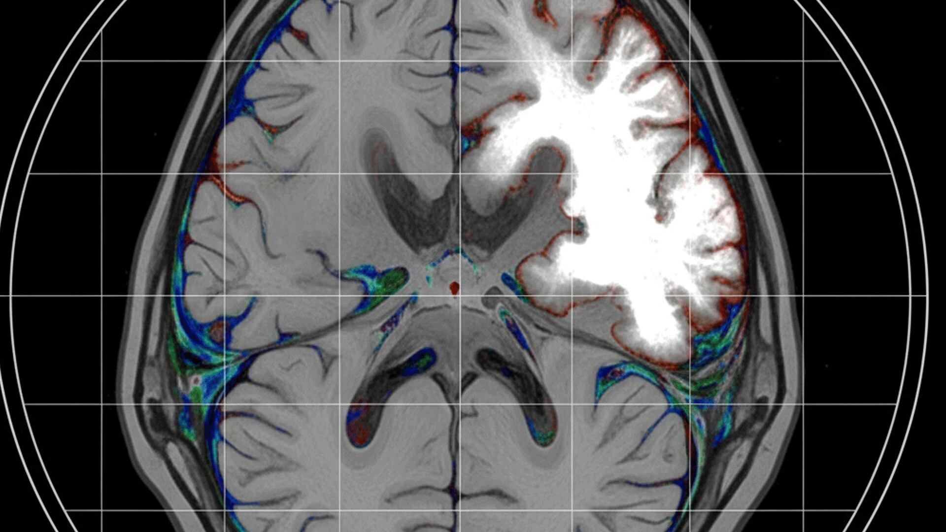 Prueba de imagen de diagnóstico de ictus