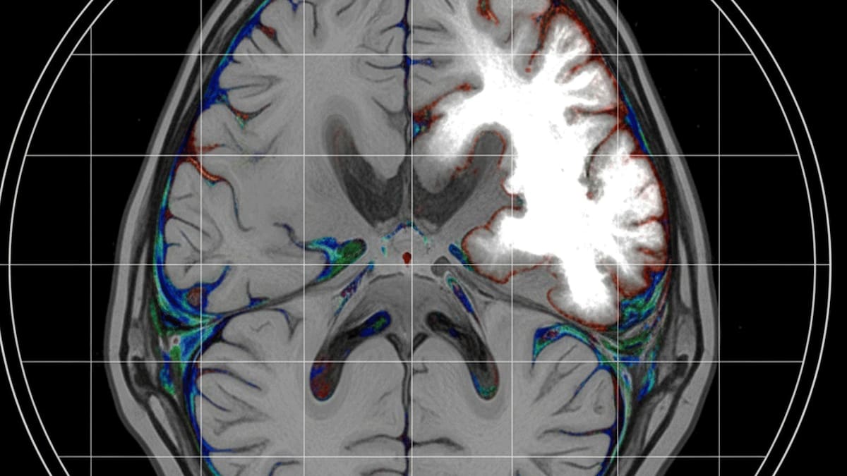 València acoge el II Congreso sobre Ictus de la Comunitat Valenciana