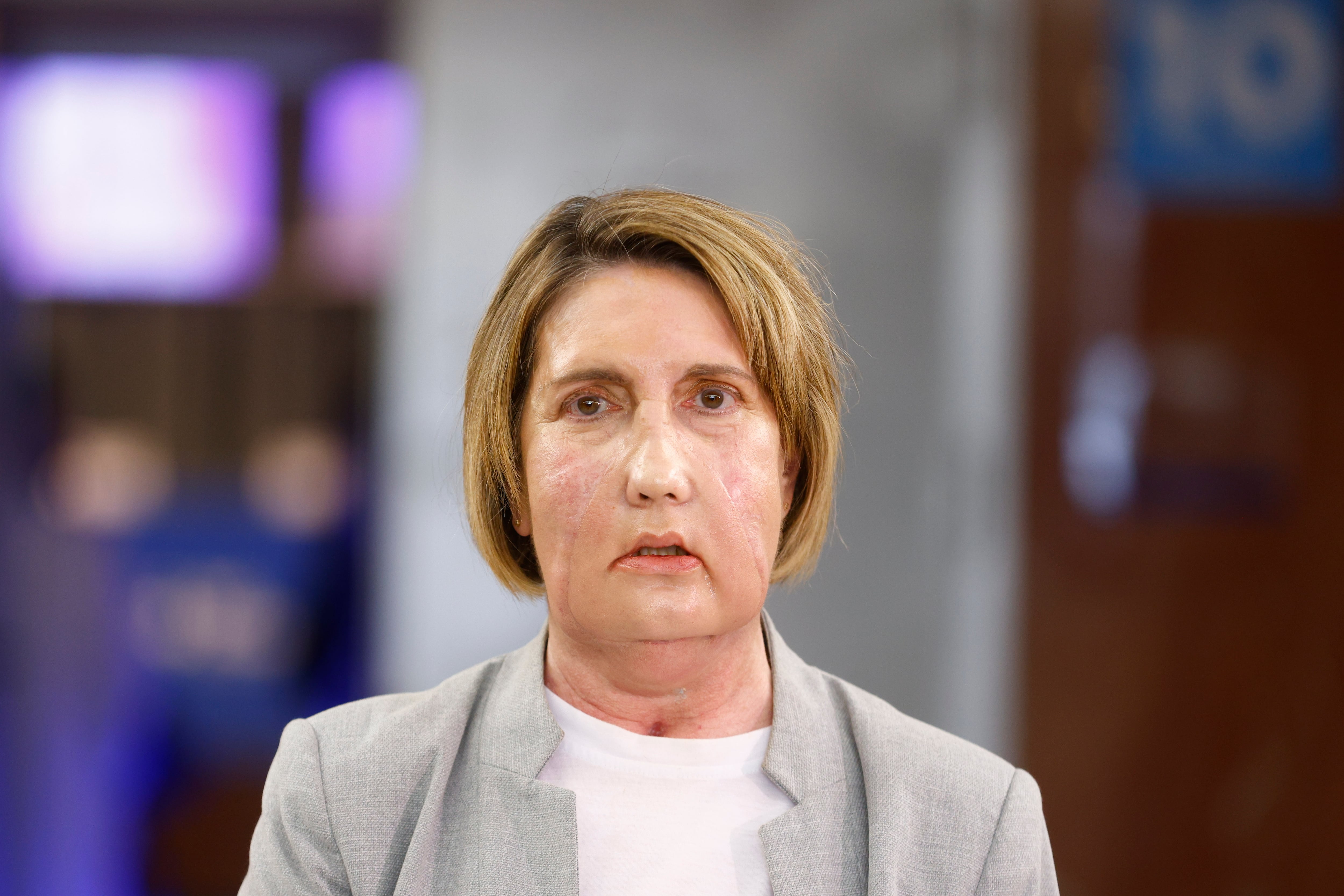 Carme, la primera paciente en recibir un trasplante de cara de una donante que recibió una eutanasia, posa para los medios de comunicación antes de la rueda de prensa que se ha celebrado en el Hospital Vall d'Hebron de Barcelona para explicar el procedimiento