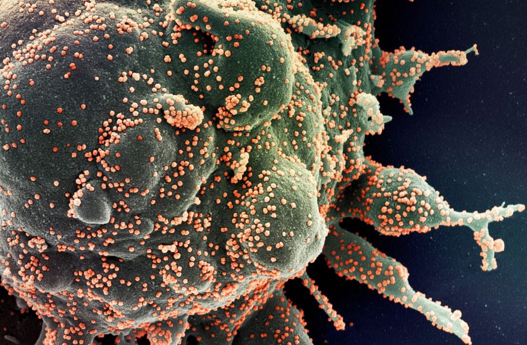 Micrografía electrónica de barrido coloreada de una célula apoptótica, en verde, infectada con partículas del virus SARS-COV-2, en color naranja, aislada de una muestra de paciente, capturada y mejorada por Centro de Investigación Integrada del Instituto estadounidense de Alergia y Enfermedades Infecciosas (NIAID), en Hamilton.