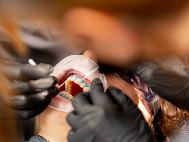 close up dental up office girl dentist applies protective gel to the gums of a young guy