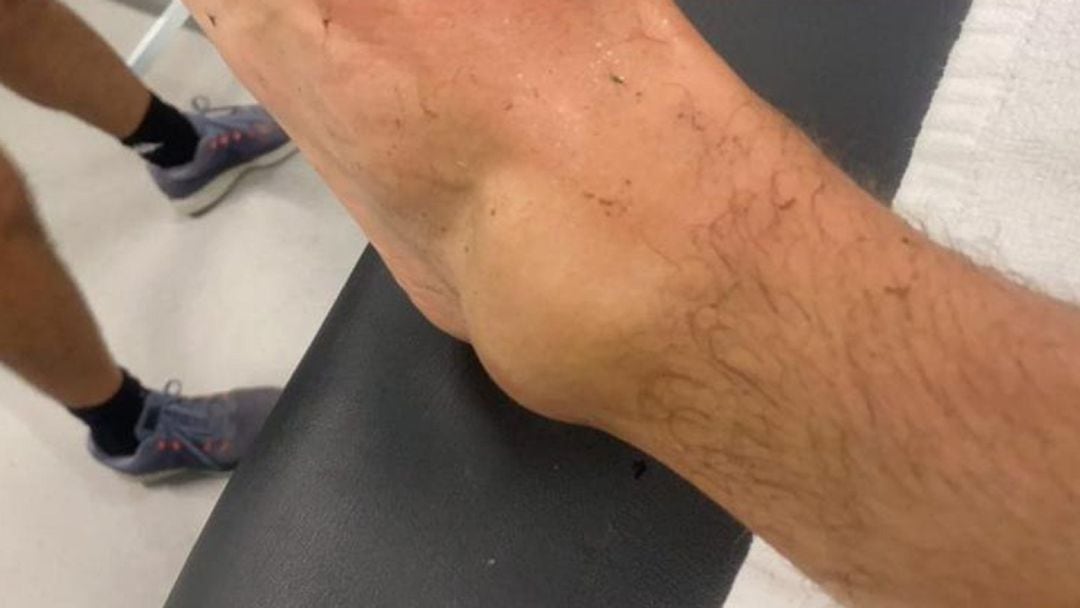 Els esquinços de turmell són una de les lesions més prevalents entre els 'esportistes de cap de setmana'