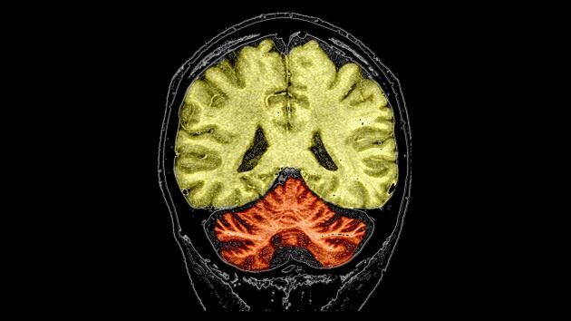 Resonancia magnética coloreada de un paciente con un largo historial de abuso de alcohol