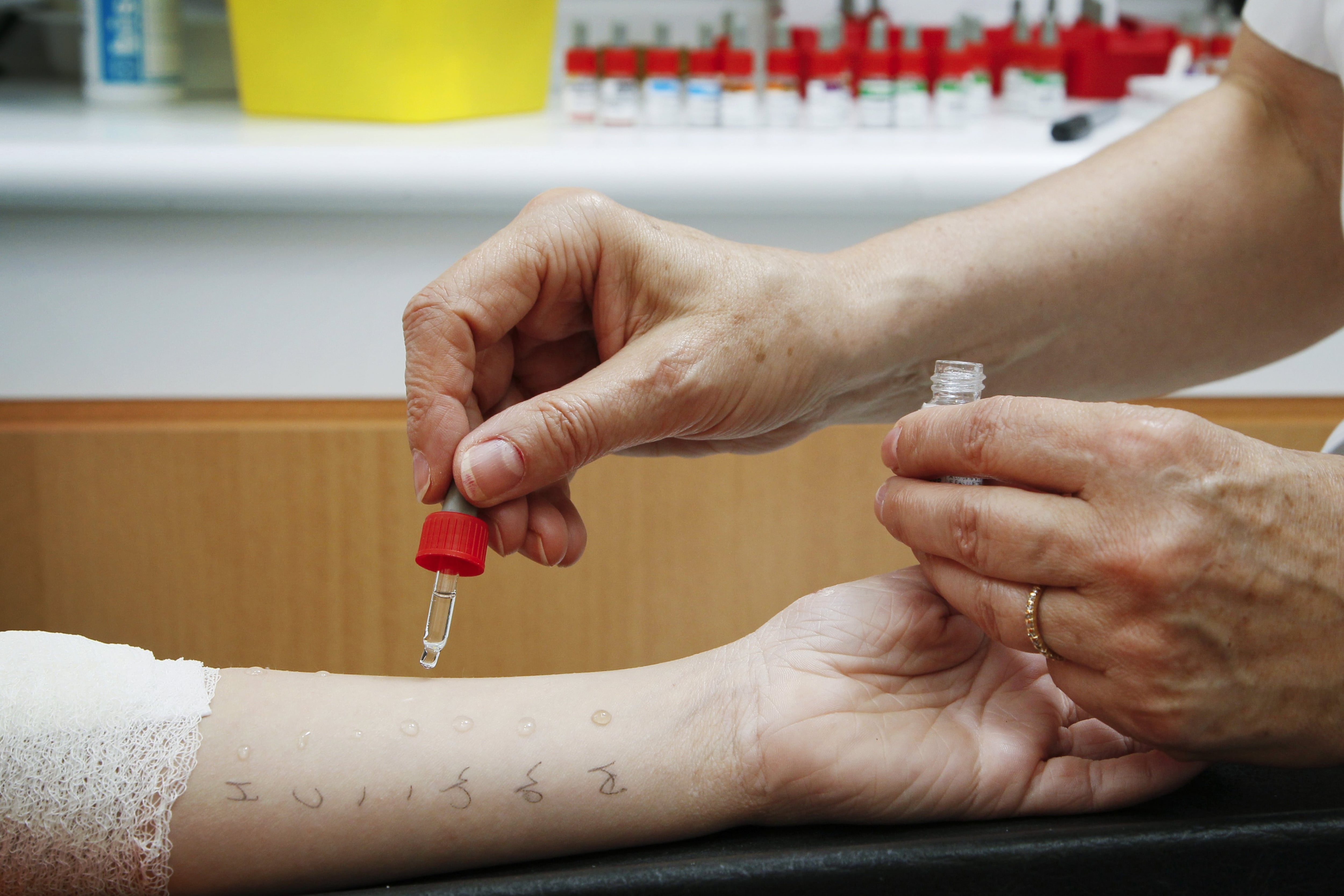 Allergology department of Saint-Vincent de Paul hospital, GHICL, Lille. Food Allergies, Prick test using reference allergens, on a boy's skin. (Photo By BSIP/Universal Images Group via Getty Images)