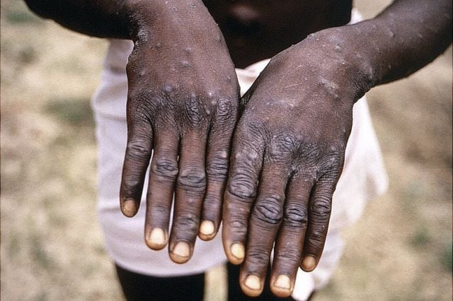 El virus mpox provoca ampollas en varias partes del cuerpo