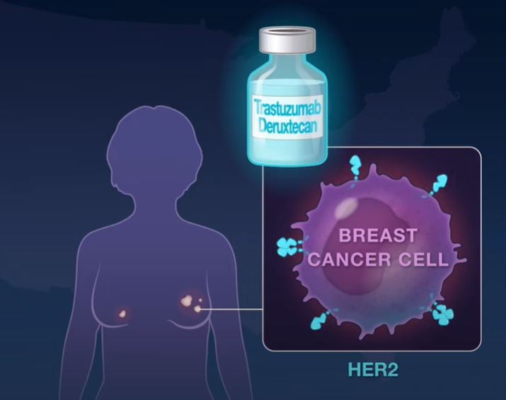 El fármaco trastuzumab deruxtecan pertenece a los llamados ADCs (Antibody-drug conjugates), un tipo de fármacos compuestos por un anticuerpo que lleva unidas diferentes moléculas de quimioterapia