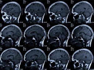 Un especialista atendrà per videoconferència els casos d&#039;ictus que es produeixin arreu de Catalunya