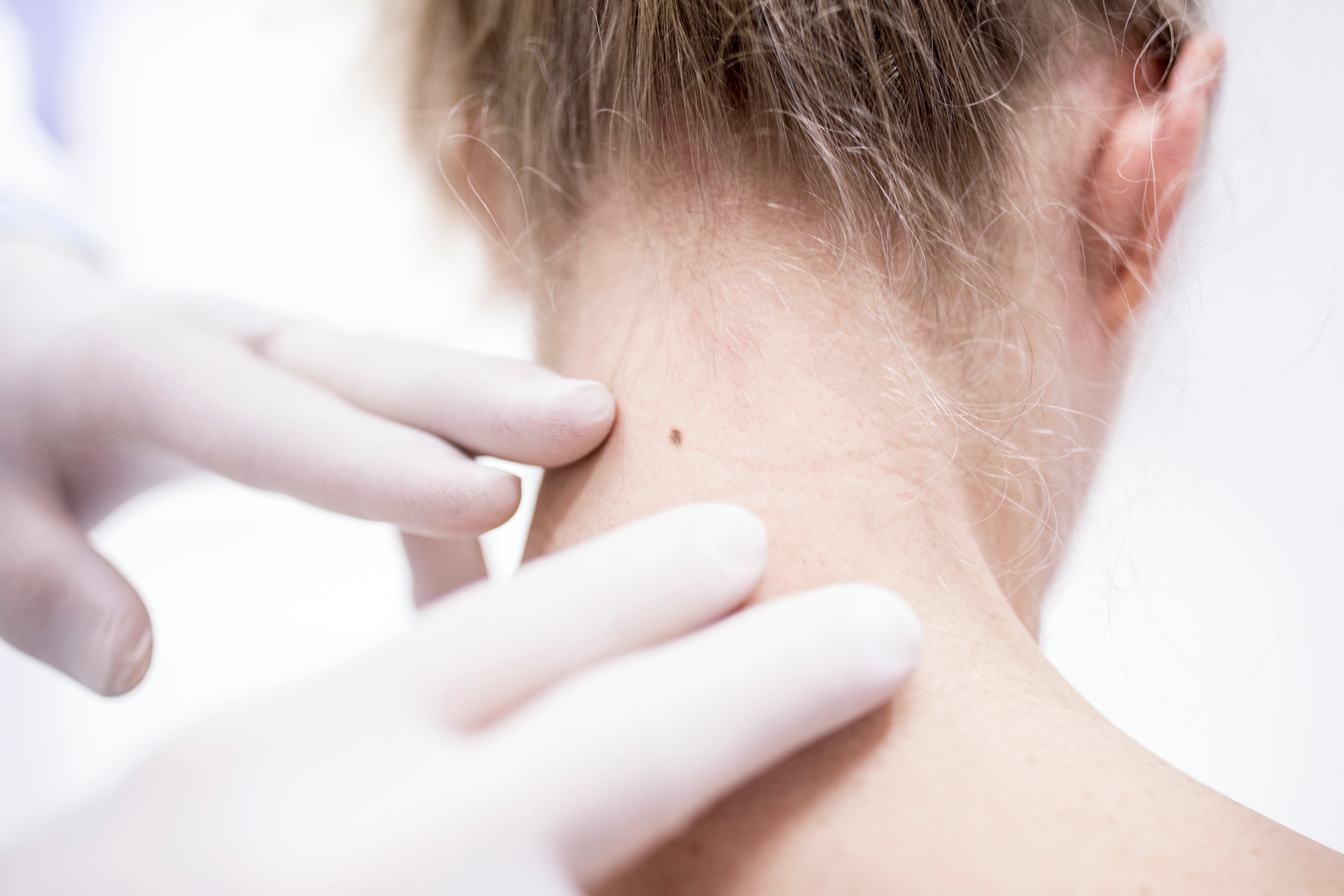 Doctor examining patient&#039;s mole on neck.