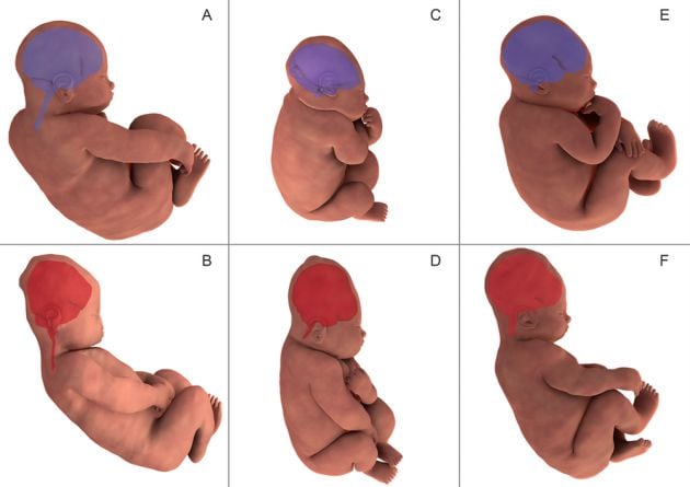 La reconstrucción tridimensional de la resonancia cerebral fetal muestra la forma del cerebro de un bebé antes de parto (en morado en las imágenes A, C y E) y durante la segunda etapa del parto (en naranja en las imágenes B, D y F).