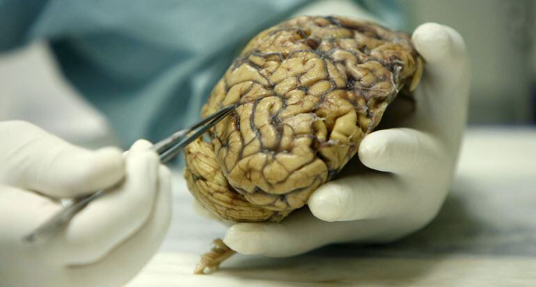 Un científico muestra un cerebro afectado por la enfermedad de alzhéimer, la llamada &quot;epidemia del siglo XXI&quot;.