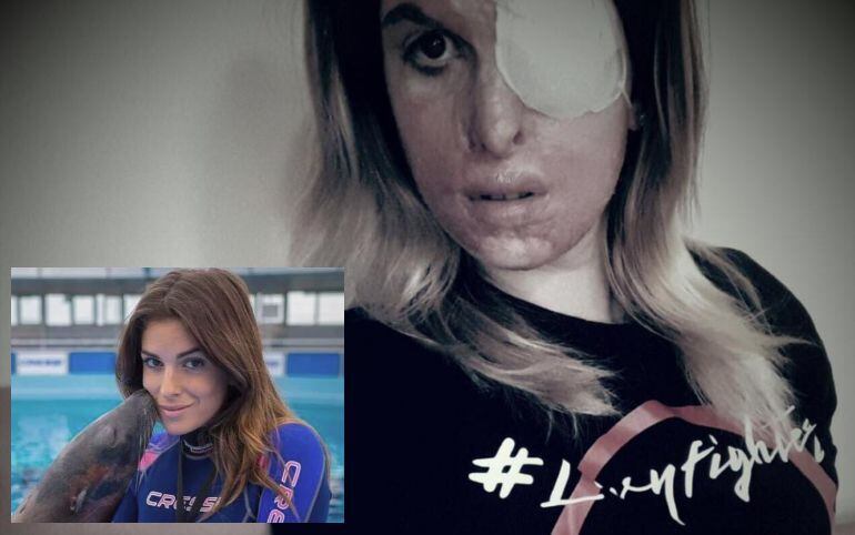 El rostro de Gessica está desfigurado por el ácido que su novio le arrojó.