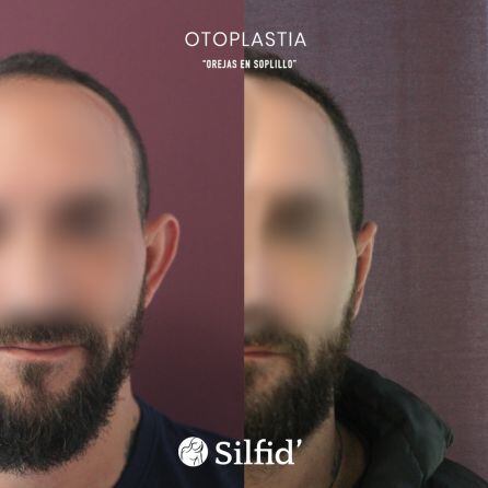 Operación orejas hombre