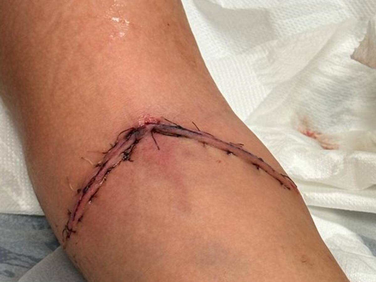 Sufre graves heridas al engancharse con un cerramiento de un parque en mal estado