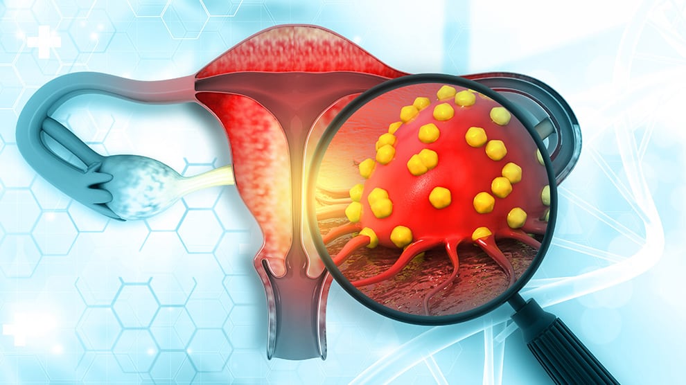 Cáncer de cérvix o cuello uterino.