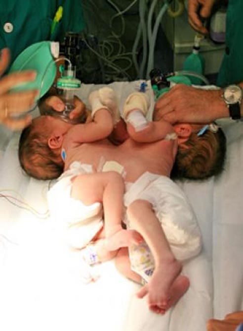 Imagen de las dos niñas antes del inicio de la intervención sin precedentes realizada en el Hospital Virgen del Rocío de Sevilla.