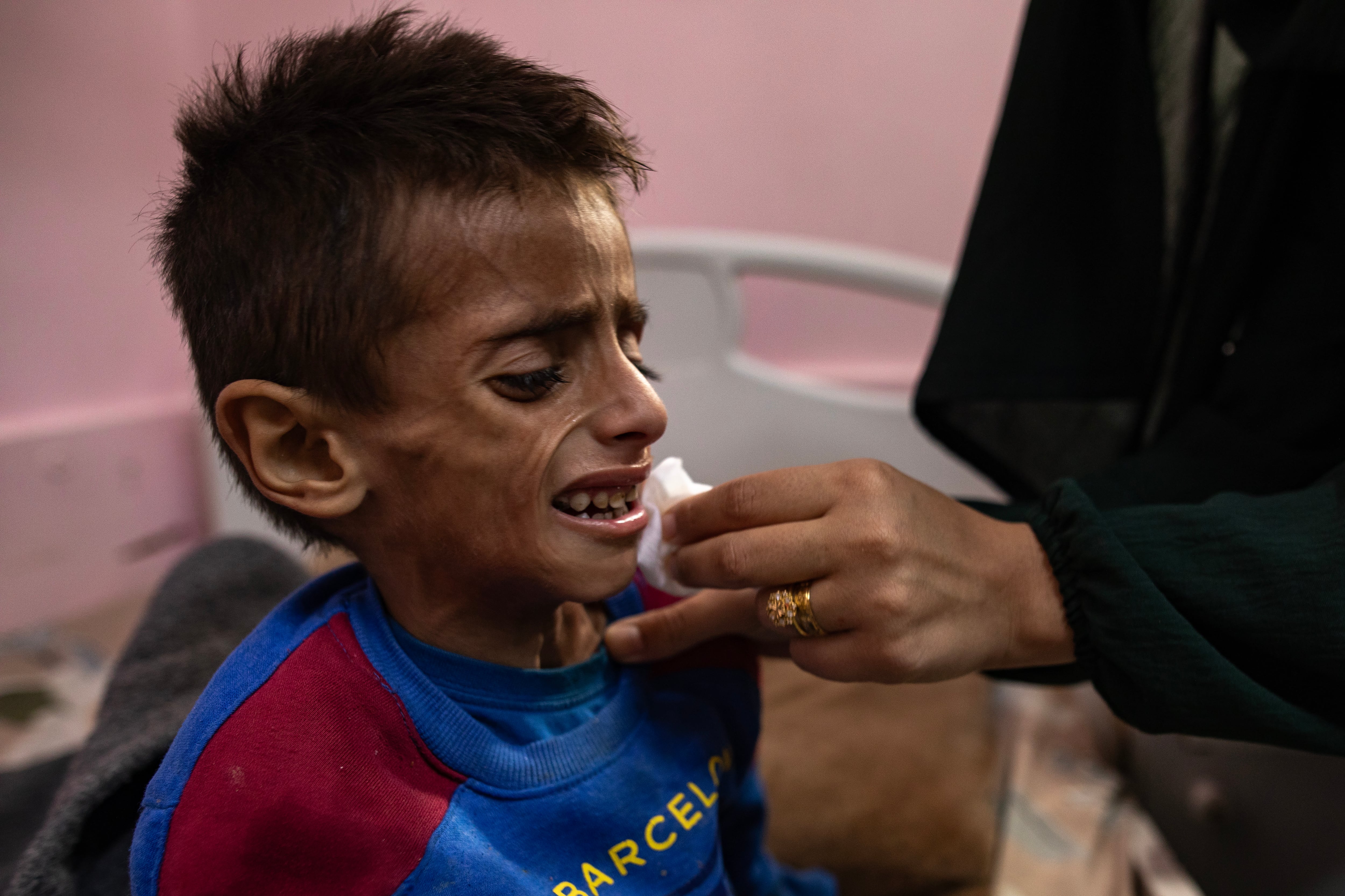 Un niño sufre los efectos de malnutrición porque Israel bloquea la ayuda humanitaria. EFE/EPA/HAITHAM IMAD ATTENTION EDITORS: UPSETTING CONTENT