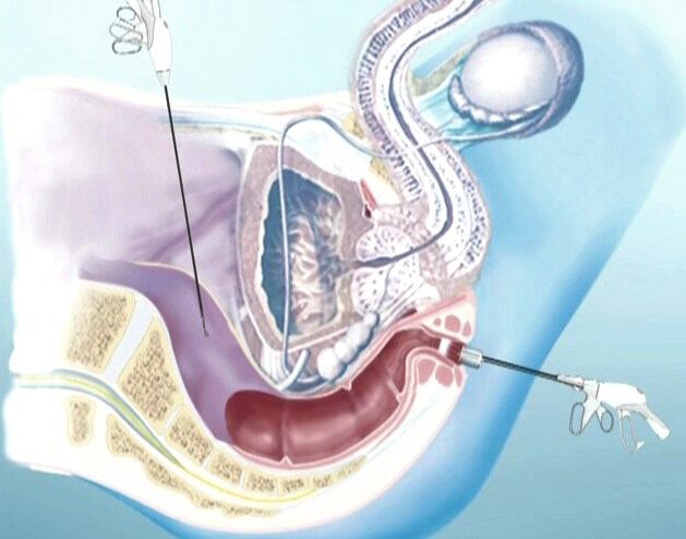 Gràfic de la intervenció d&#039;extracció del colon per l&#039;anus