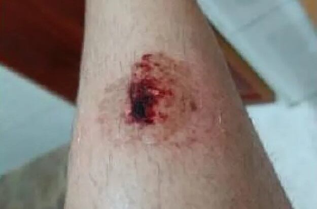 Una de las heridas sufridas por uno de los policías nacionales agredidos en Fuenlabrada.