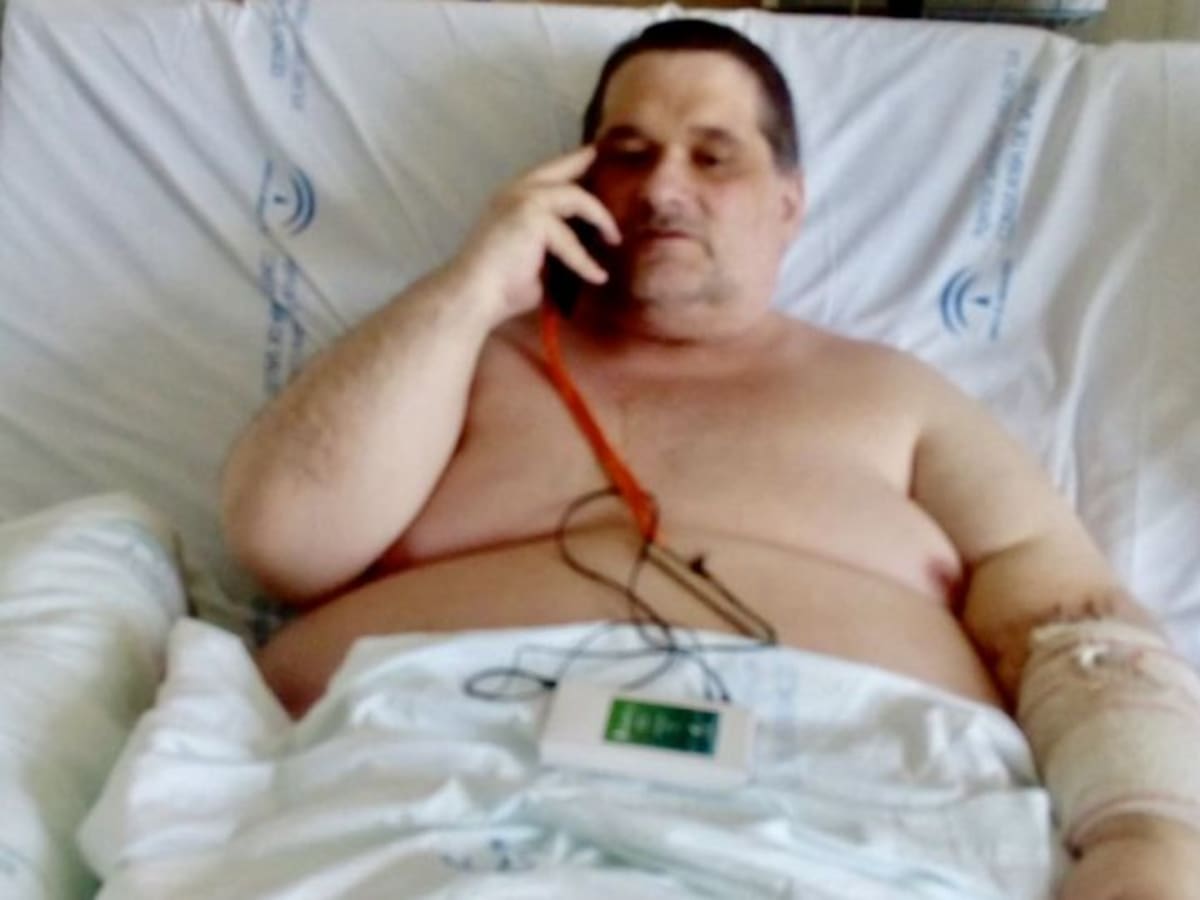 El hombre hospitalizado con obesidad mórbida pierde cien kilos en cinco meses