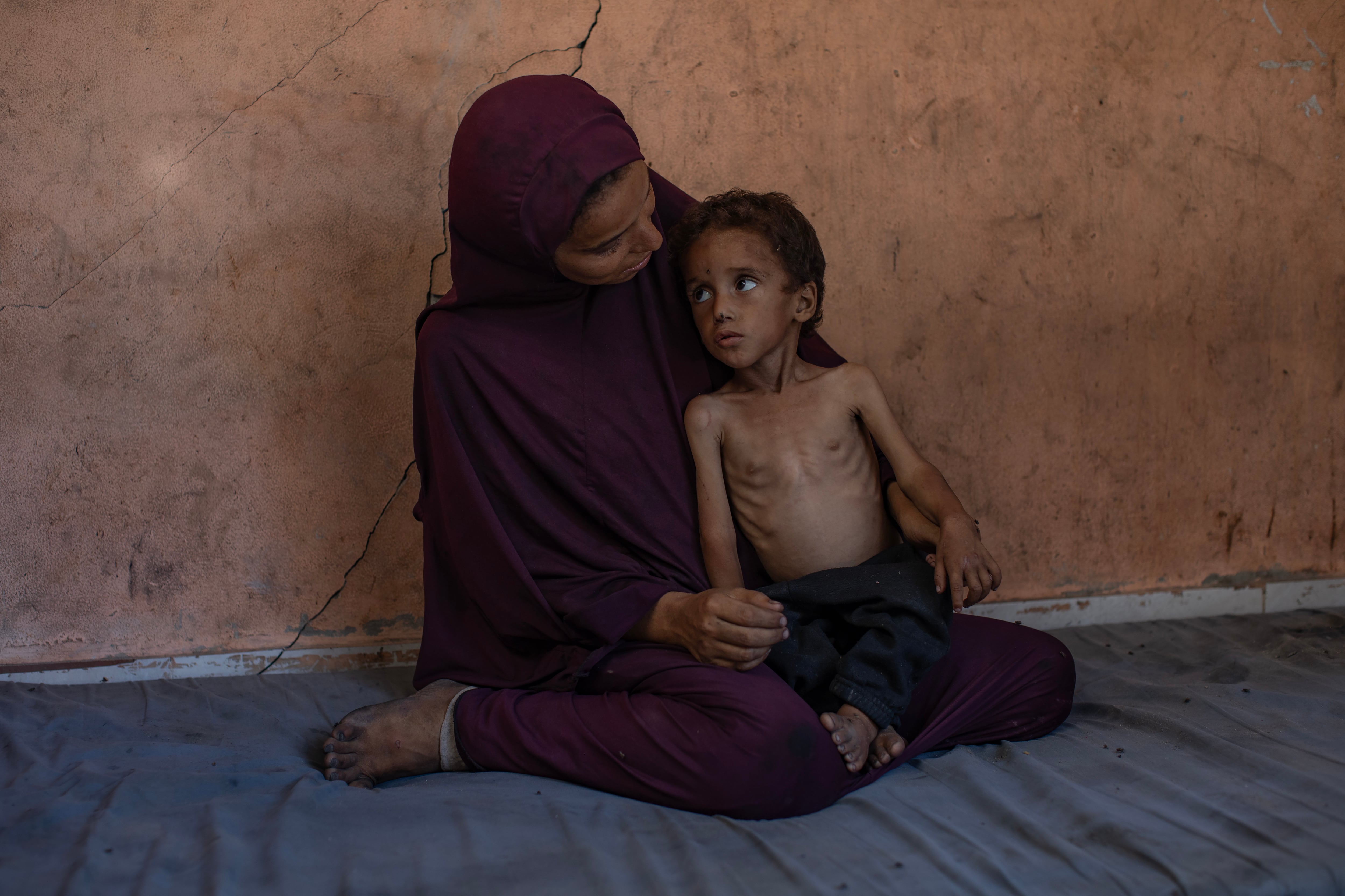 Una madre muestra a su hijo con malnutrición en Gaza.