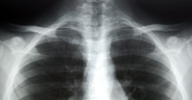 Imatge d'una radiografia d'uns pulmons