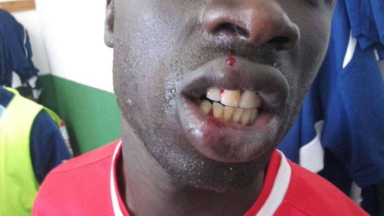 El jugador del Alma de África recibió varios puntos de sutura en el labio tras la agresión