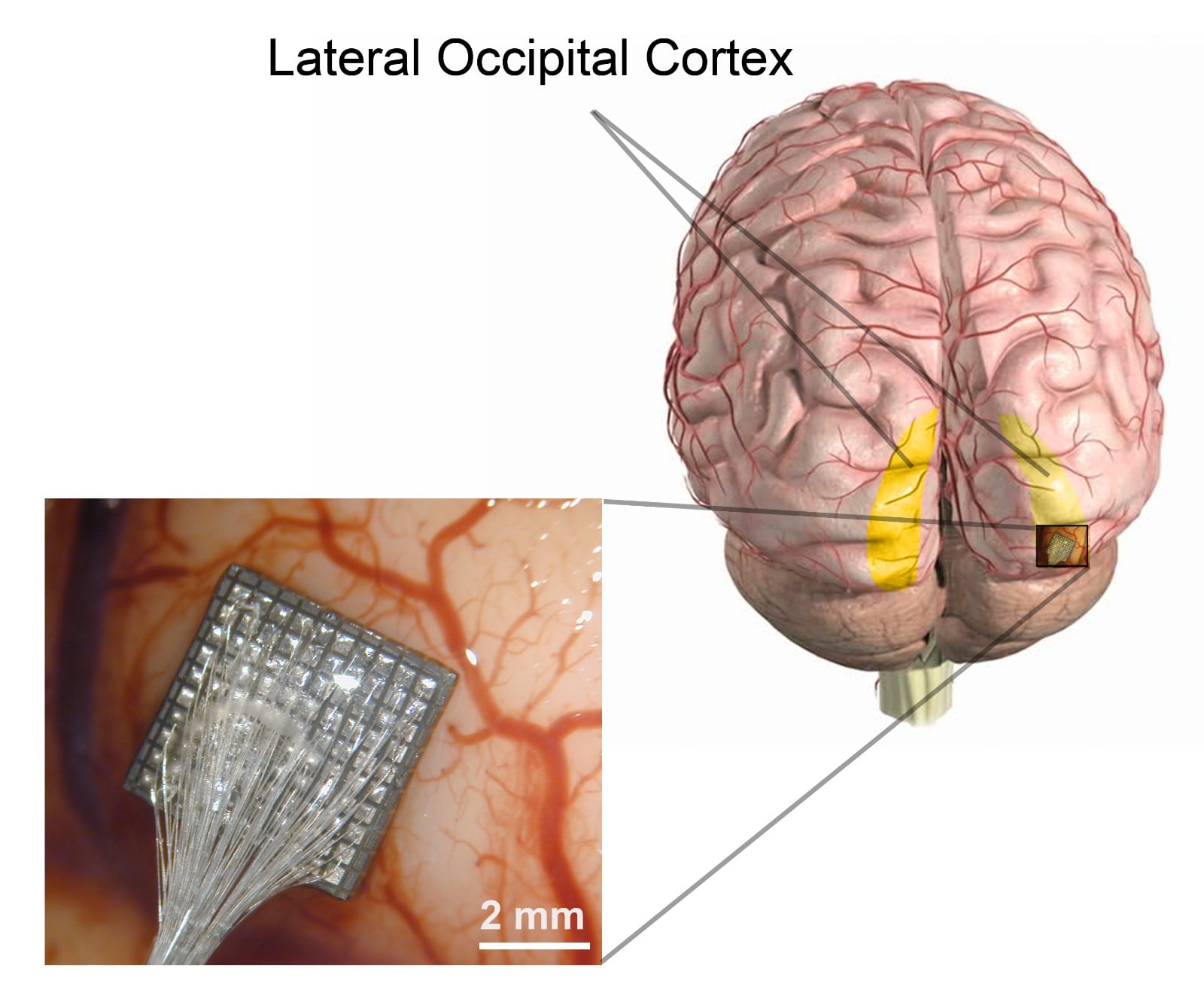 Punto del cerebro donde se colocan los electrodos que permiten a un paciente ciego percibir formas y letras. Credito: Universidad Miguel Hernandez de Elche