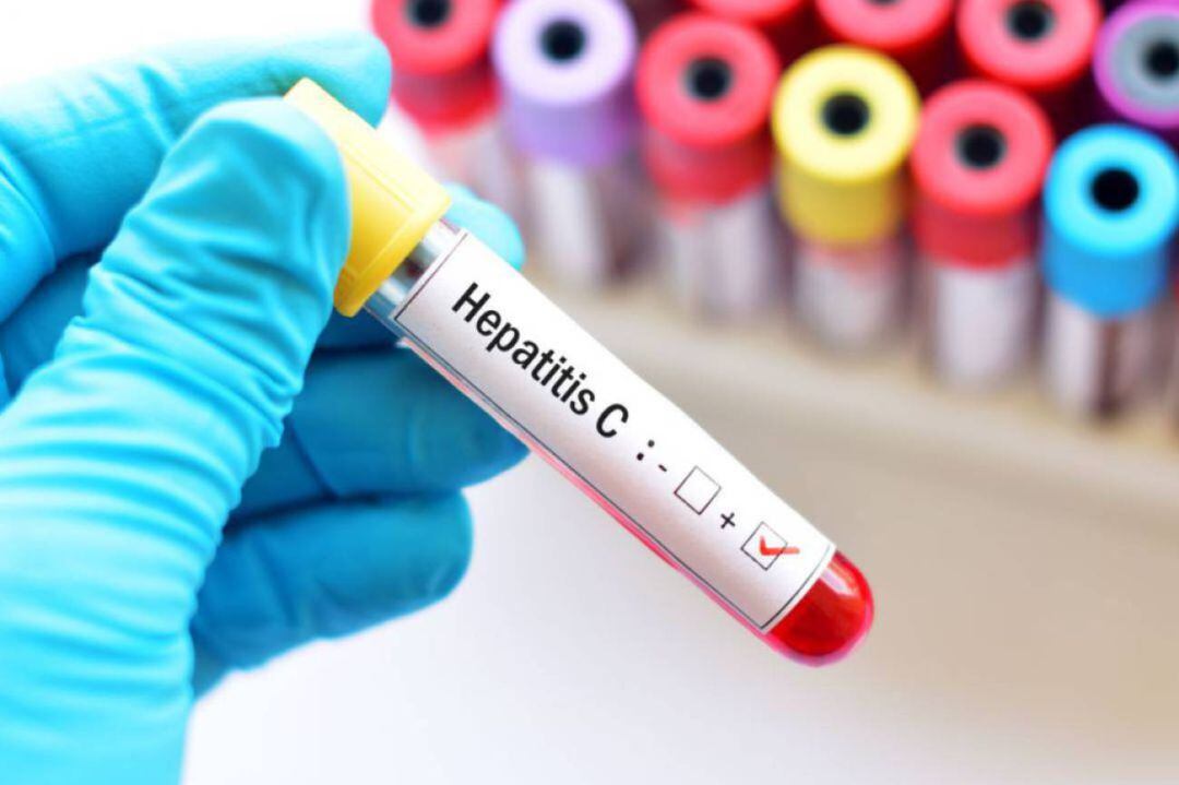 Analítica de sangre para prueba Hepatitis C