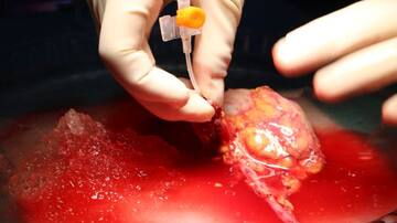 CINCO HORAS, DOS HERMANOS Y UN RIÑÓN