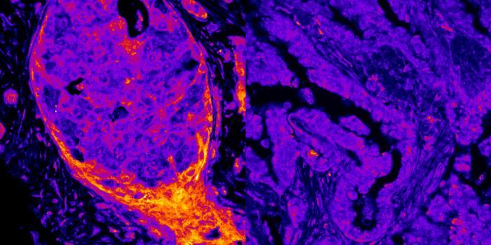 A la izquierda, un cáncer de mama. A la derecha, un cáncer de pulmón. El primero muestra claramente niveles más elevados de enzimas productoras de energía lo que revela un metabolismo propio.