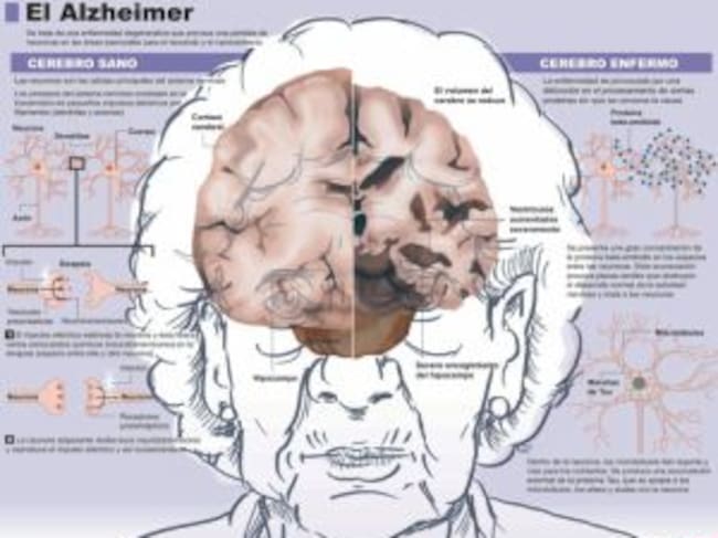 Cerebro enfermo frente a un cerebro sano