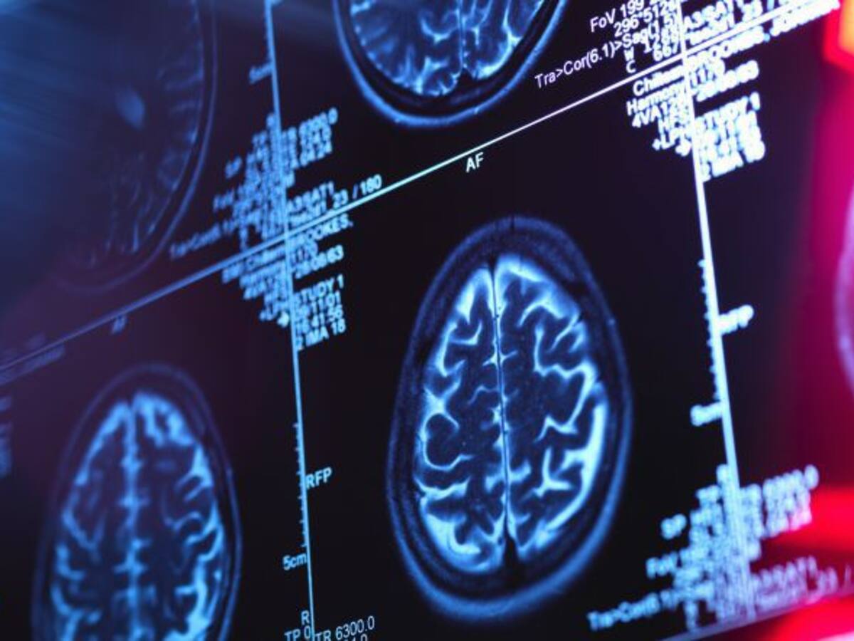 "Trabajamos para que en unos años podamos adelantarnos al alzheimer en pacientes sin síntomas"