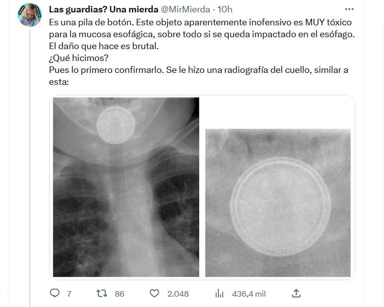 La radiografía de un esófago con una pila de botón que compartió este médico en Twitter