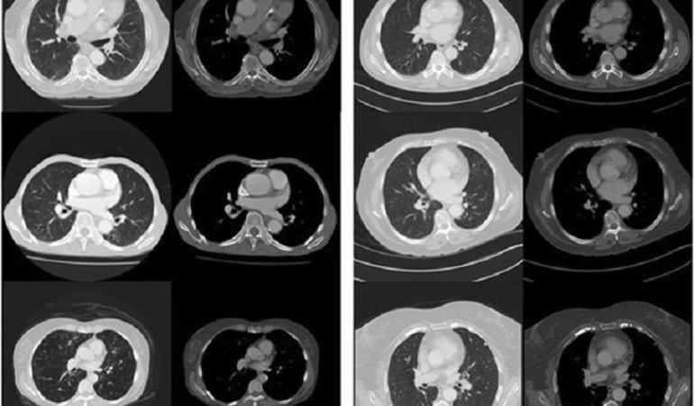 Distintos tipos en el análisis de la arteria coronaria.