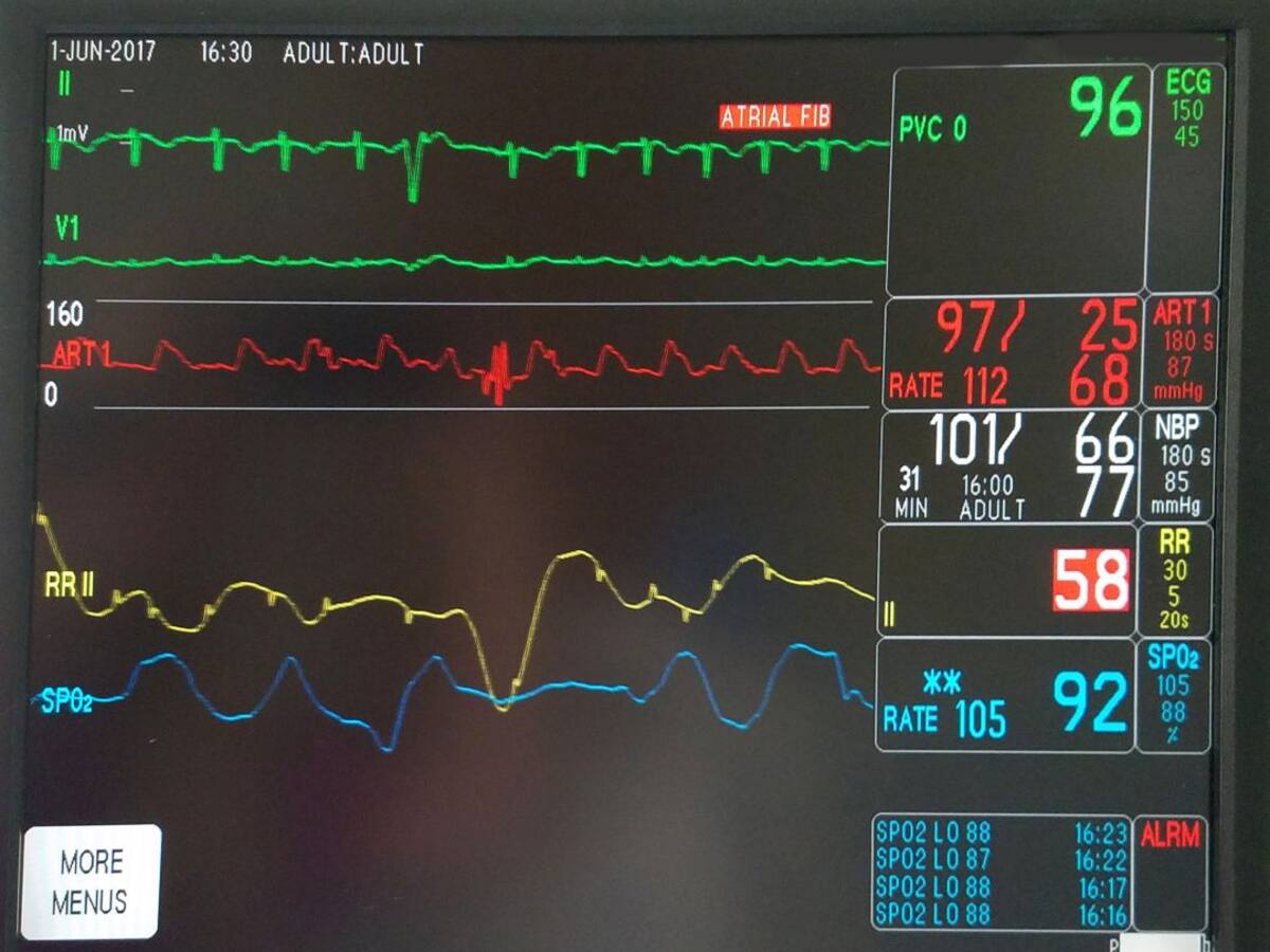 Secuelas del covid para pacientes coronarios