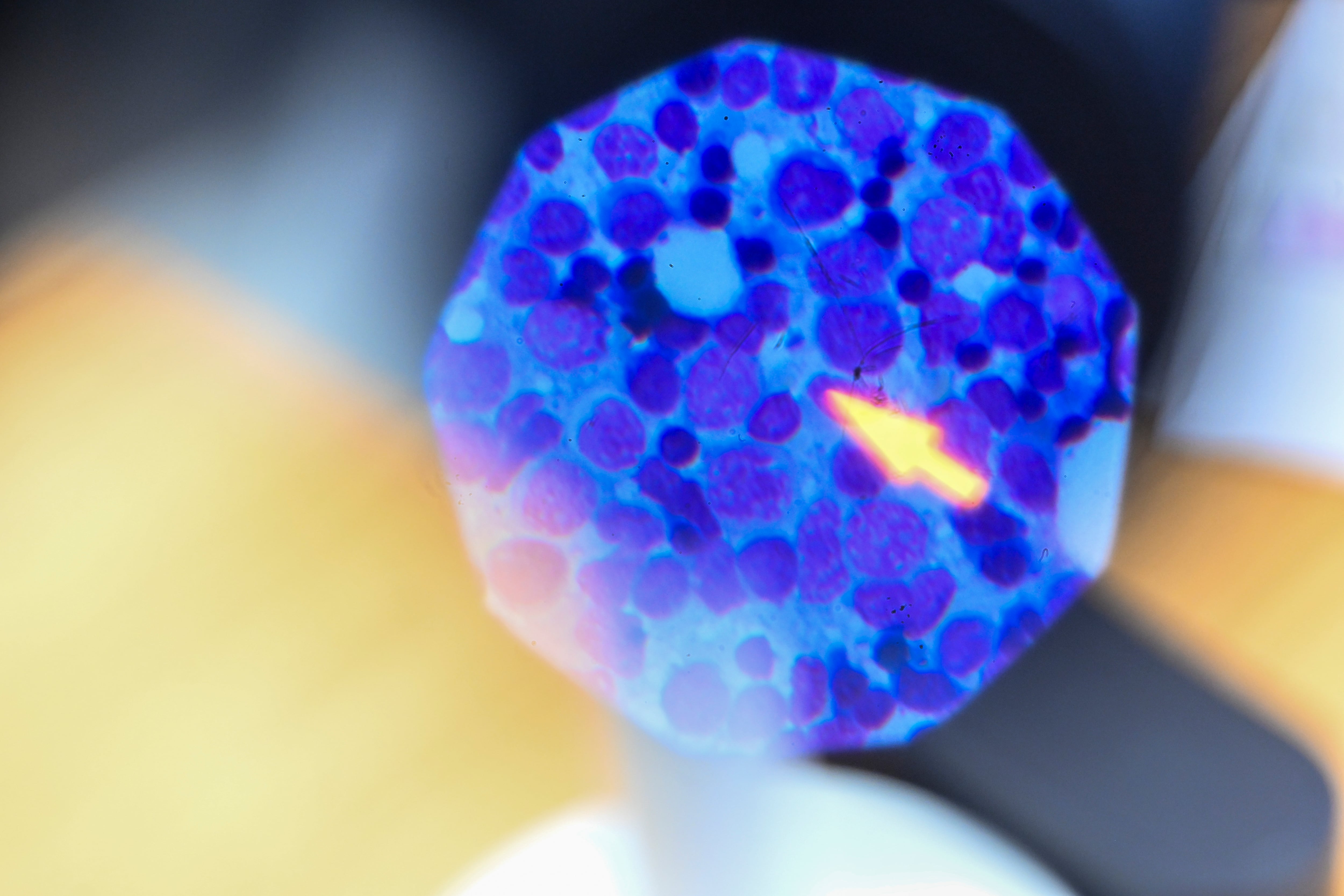 Células de leucemia.