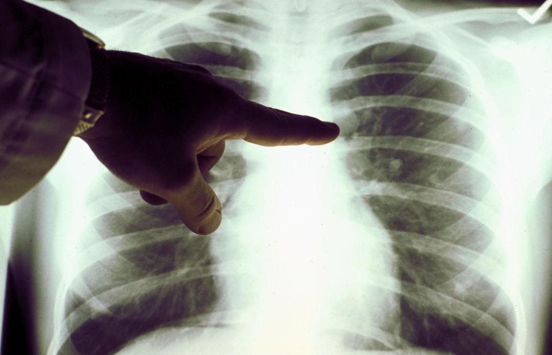 Radiografía de unos pulmones.