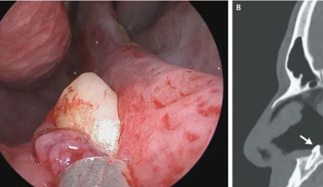 La fotografía de la nariz del hombre al que le creció un diente.