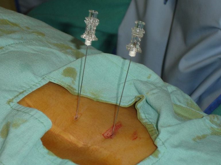 Agujas específicas para radiofrecuencia