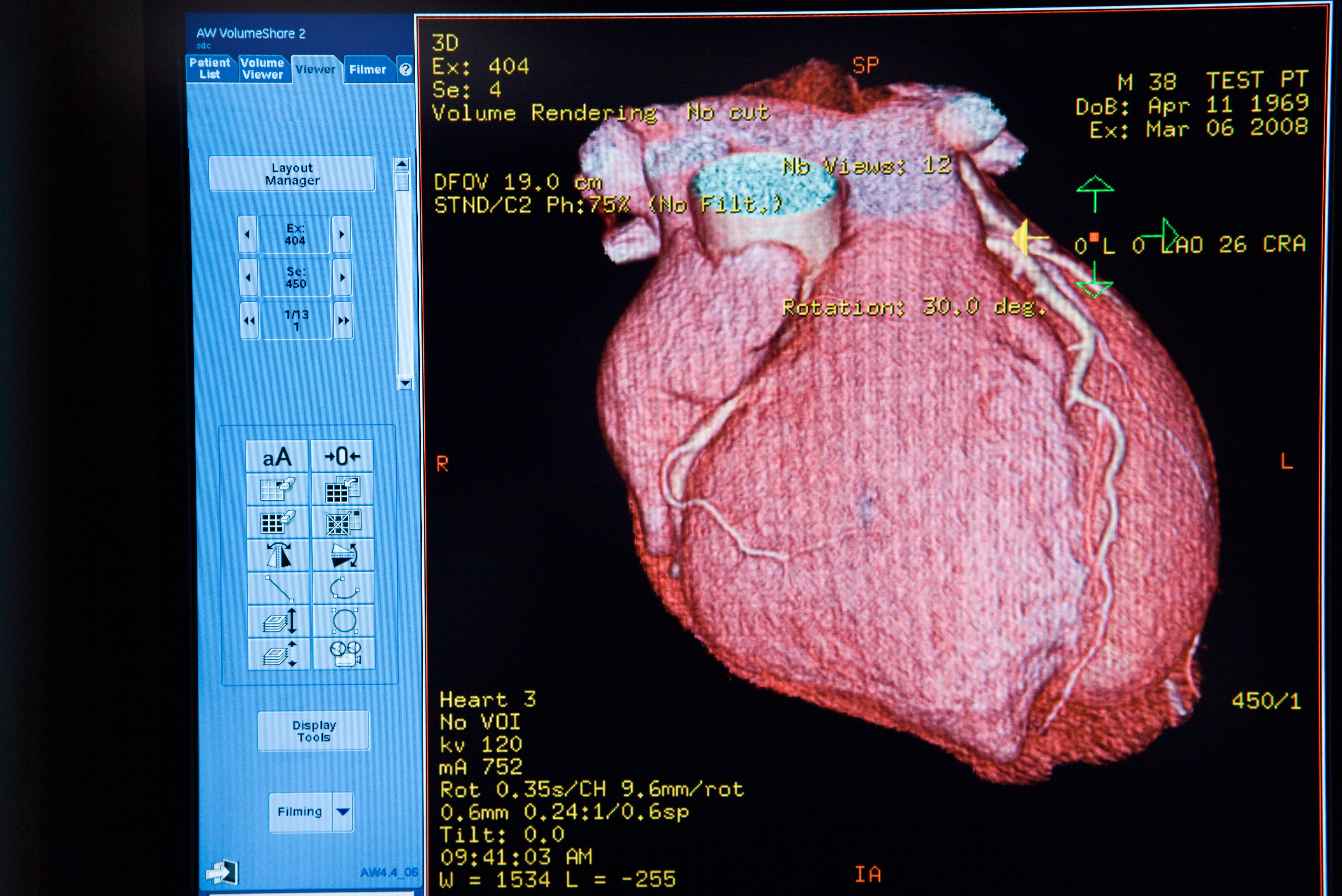 Tomografía de un corazón