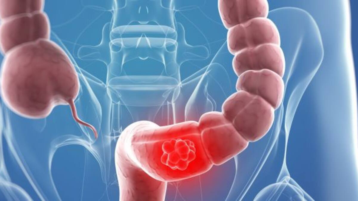 El código postal determina el riesgo de morir por cáncer de colon en España