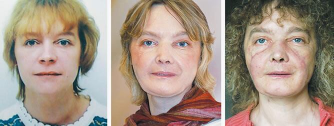 La imagen de Isabell antes de sufrir el accidente. Y hacia la derecha, un año y 18 meses después de la operación.