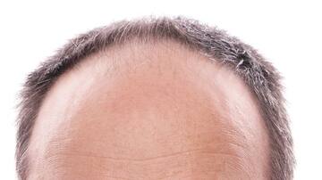 Una nueva esperanza para el fin de la calvicie: unos investigadores cultivan sus propios folículos pilosos